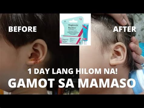 Gamot sa mamaso o impetigo .